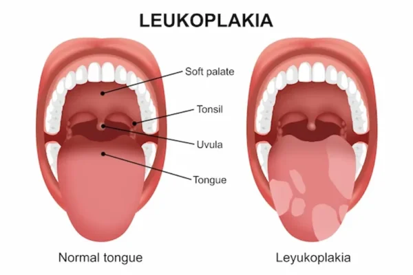 Laser Therapy vs. Medication: Which Leukoplakia Treatment Works Better?