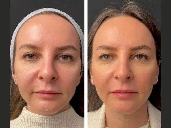 Best Doctors in Dubai with Proven Results in Mesotherapy Treatments