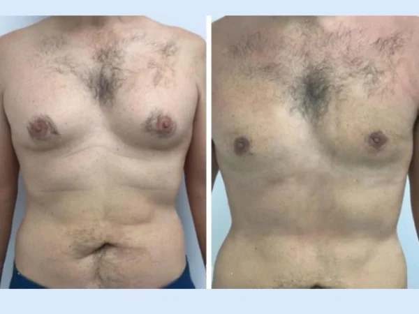 Safety Measures Followed by Best Doctors in Dubai for Gynecomastia Procedures
