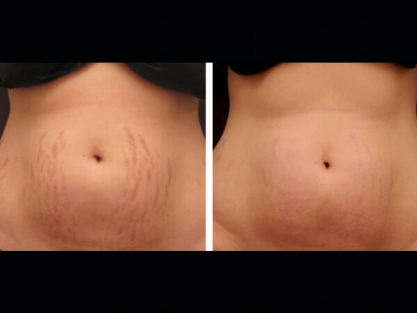 Dramatic Skin Renewal with Radiofrequency (RF) Microneedling Treatments in Dubai