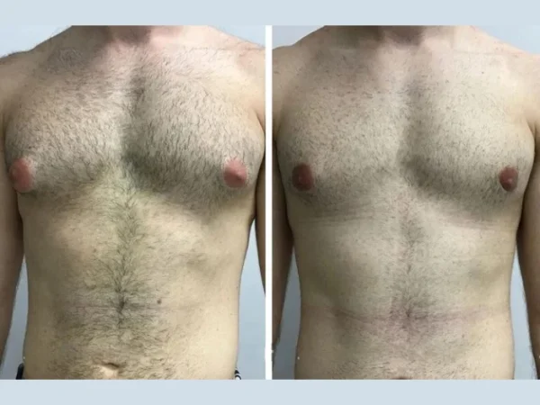 How the Best Gynecomastia Surgeon in Dubai Helps Men Regain Confidence