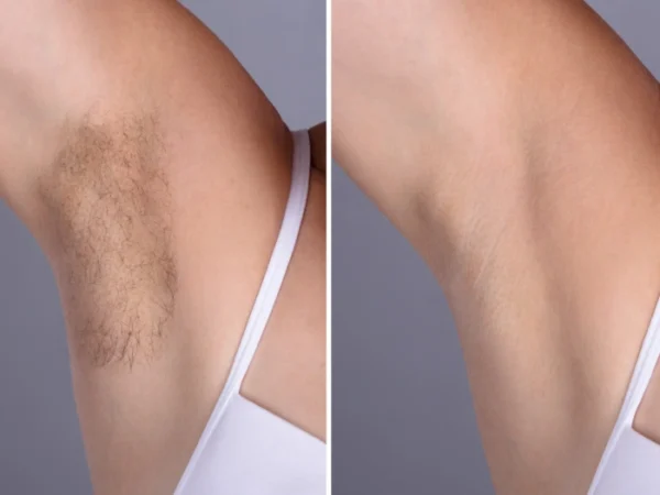 Best Doctors in dubai for Sensitive Skin Electrolysis Laser hair removal