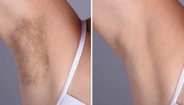 Electrolysis Laser hair removal treatment in dubai: Safe, Fast, and Effective Solution