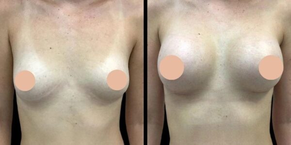 How the Best breast augmentation Surgeon in Dubai Personalizes Breast Augmentation Surgery