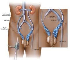 Varicocele embolisation